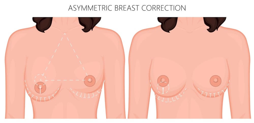 breast assymetry