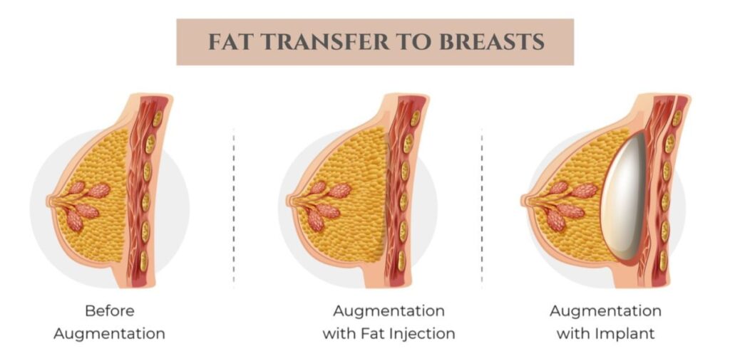 fat transfer to breasts